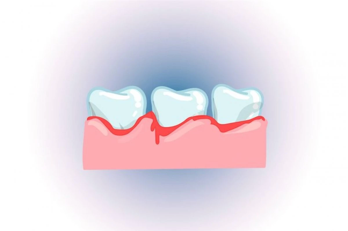 Gây nhiễm trùng nướu: Khi nhai đá lạnh, nướu của bạn rất dễ bị tổn thương do các cạnh cứng và sắc của đá, dẫn đến viêm nướu hoặc nhiễm khuẩn nướu. Thay vì nhai đá, bạn nên ngậm cho đá tan dần hoặc nhai những thực phẩm mềm như kẹo cao su không đường.