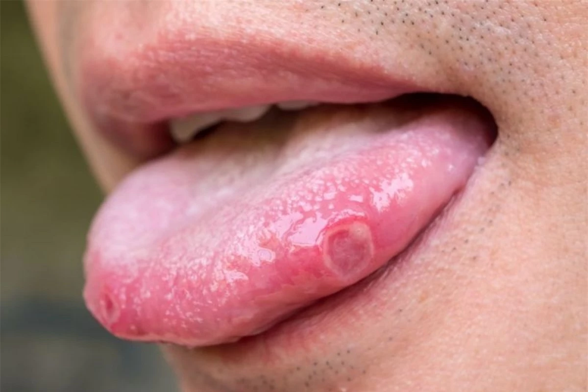 Nhiệt miệng: Những vết nhiệt trên lưỡi trông có thể đáng sợ và còn gây đau đớn vô cùng, nhưng rất may là chúng không lây lan. Có nhiều nguyên nhân gây nhiệt miệng, bao gồm việc sử dụng dược phẩm, dị ứng thức ăn và căng thẳng.
