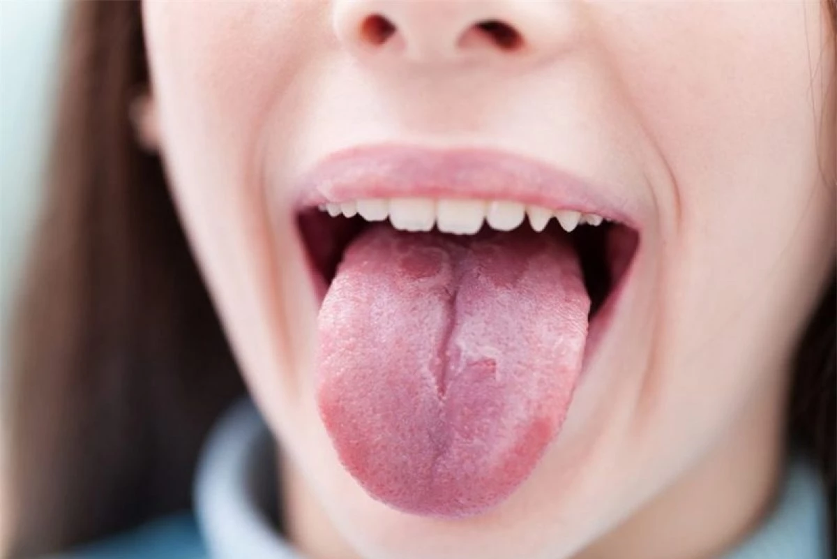Lưỡi địa lý: Lưỡi địa lý là một bệnh lý gây ra các mảng “hói” trên lưỡi ở những vị trí mà nhú lưỡi bị vi khuẩn tấn công. Người mắc bệnh lý này sẽ cảm thấy đau nhói và nóng rát ở lưỡi khi ăn đồ cay nóng hoặc đồ mặn.