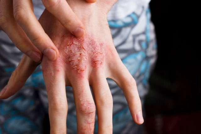 Tẩy giun định kỳ có phòng được bệnh giun sán?