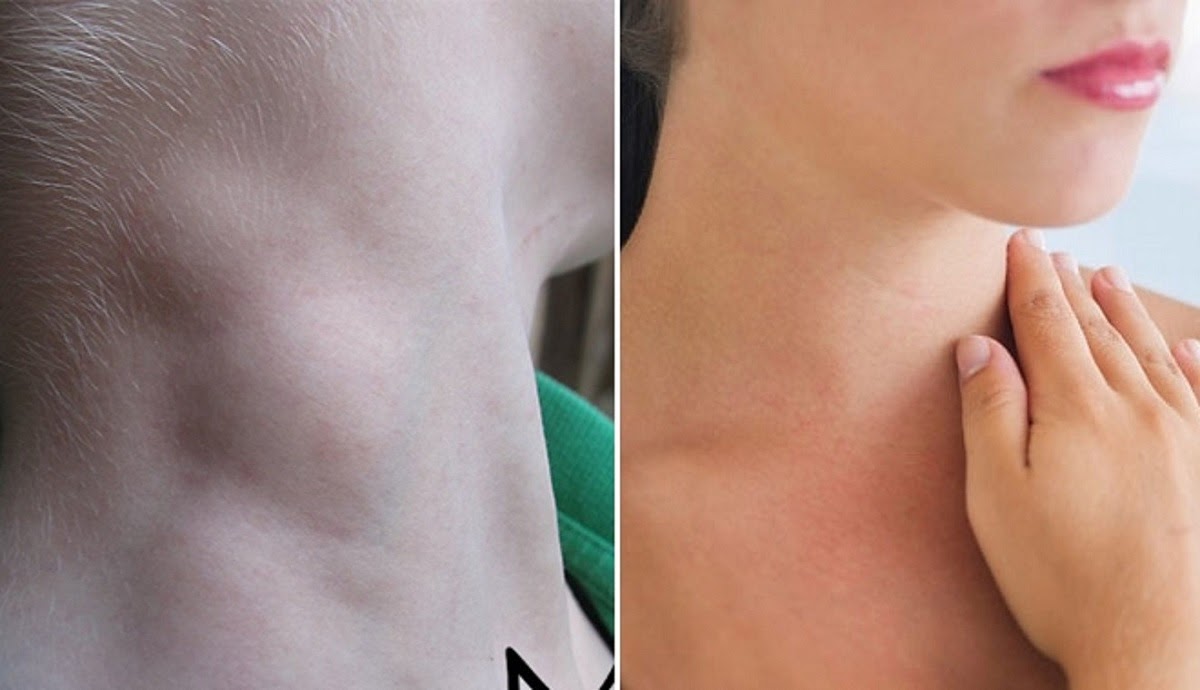 Yếu tố làm tăng nguy cơ ung thư vòm họng