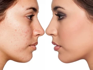 Bật mí một vài tips chăm sóc da đúng cách khi bị mụn trứng cá