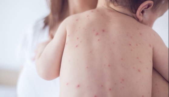 Cách chăm sóc trẻ khi bị sốt xuất huyết