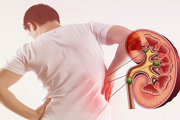 Yếu tố làm tăng nguy cơ bị sỏi thận