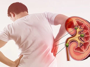 Yếu tố làm tăng nguy cơ bị sỏi thận