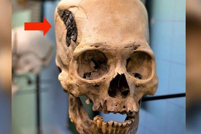 Bí ẩn hộp sọ "người ngoài hành tinh" ngàn năm gắn kim loại