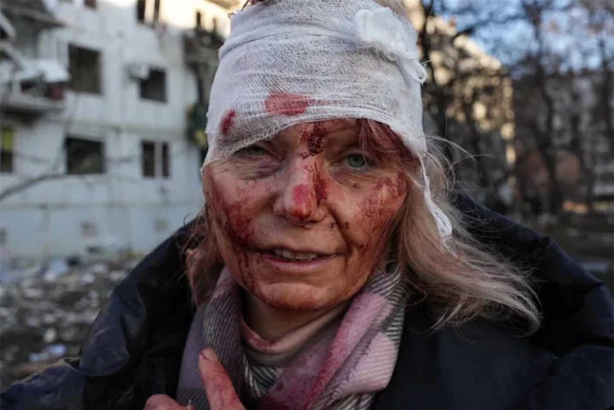 Một phụ nữ bị thương sau cuộc không kích bên ngoài Kharkiv, Ukraine. (Ảnh:Anadolu Agency)