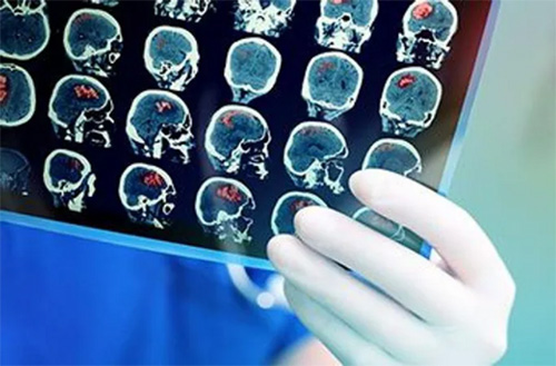 Mắc COVID-19 gây thay đổi não bộ như thế nào?