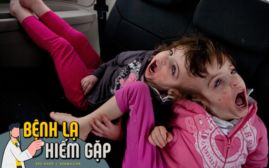 Mắc bệnh lạ, cặp song sinh bị dính liền đầu suốt cả cuộc đời, nhưng tiết lộ về "thần giao cách cảm" giữa cả hai mới khiến thế giới kinh ngạc