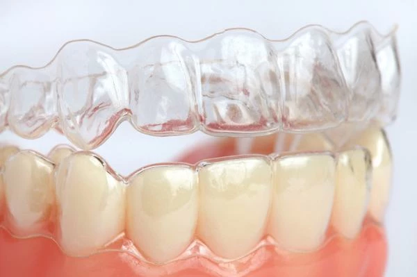 Đeo hàm duy trì giúp giữ kết quả niềng răng được ổn định.