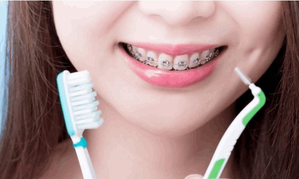 Niềng răng - Những lưu ý cần biết