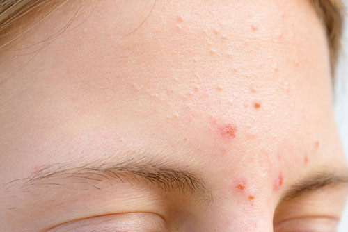 Lý do khiến bạn bị nổi mụn trên trán