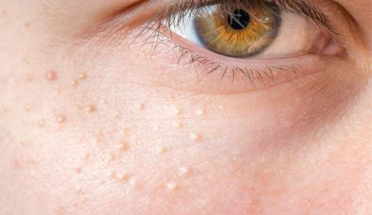 3 cách trị mụn thịt mà không tốn tiền