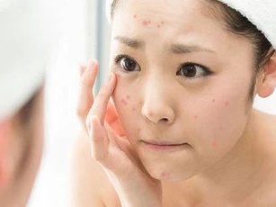 Chăm sóc da mụn đúng cách trong mùa hè