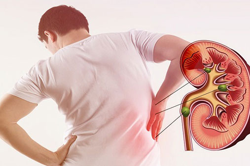 Người bị sỏi thận cần ăn gì?