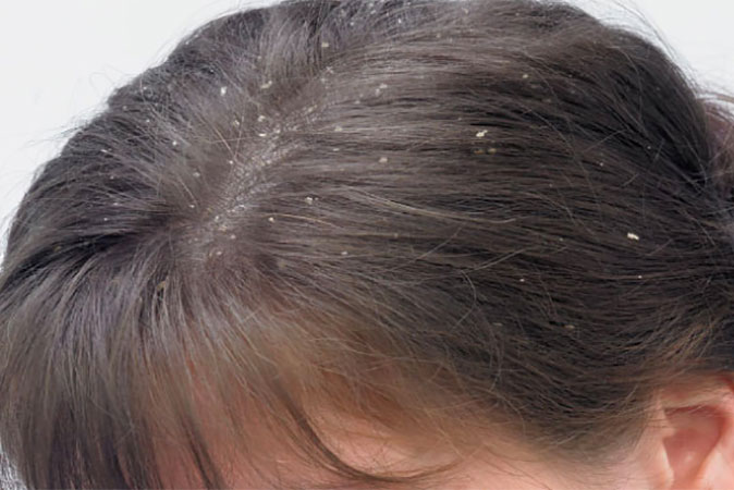 Trị sạch gàu với công thức vô cùng đơn giản