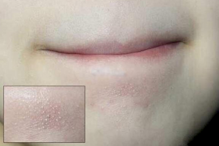 Hỗn hợp đánh bay mụn cám trong nháy mắt