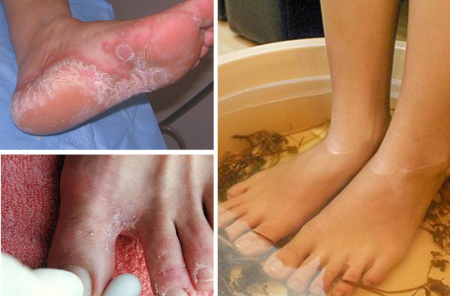 8 mẹo trị nước ăn chân cực kỳ hiệu quả