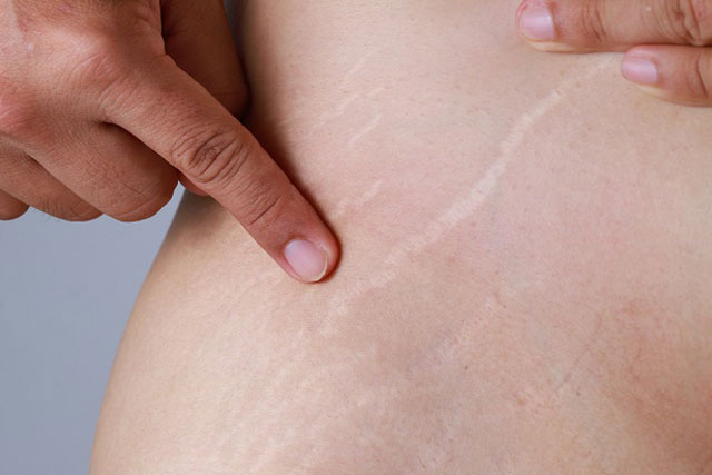 Nhóm thực phẩm ngăn ngừa rạn da cho bà bầu