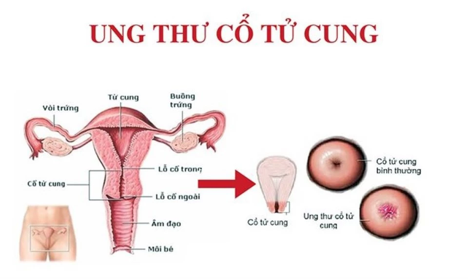 Những dấu hiệu cảnh báo ung thư cổ tử cung sớm chị em nên biết