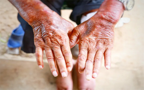 Nhận biết 5 dấu hiệu trên da cảnh báo bệnh thận để giữ mạng sống