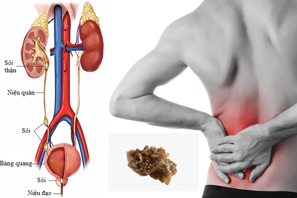 4 loại nước giúp chữa trị và phòng ngừa sỏi thận