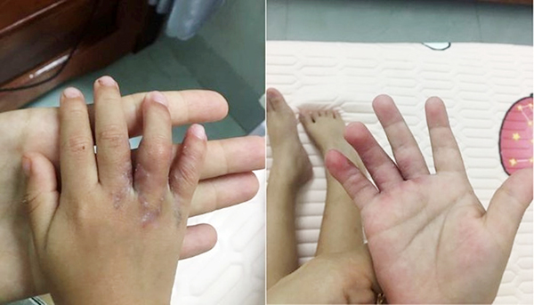 Đà Nẵng: Mổ tách thành công hai bàn tay dính ngón cho cháu bé 19 tháng tuổi