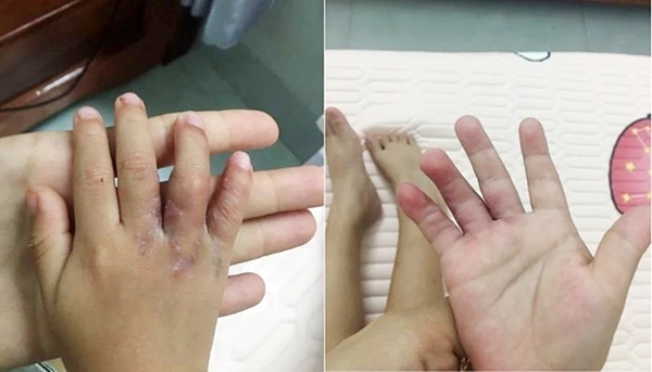 Hai bàn tay của cháu bé sau khi mổ