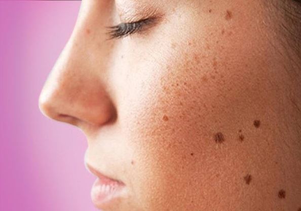 3 điều cần làm tốt để không bị đốm đồi mồi trên da