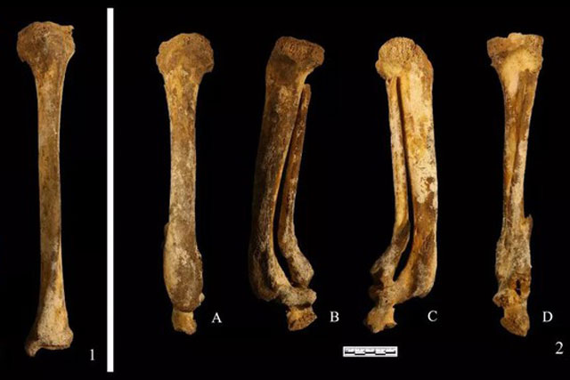 Bộ xương cổ đại tiết lộ hình phạt chặt chân phụ nữ Trung Quốc 3.000 năm trước