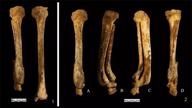Bộ xương cổ đại tiết lộ hình phạt chặt chân phụ nữ Trung Quốc 3.000 năm trước ảnh 1