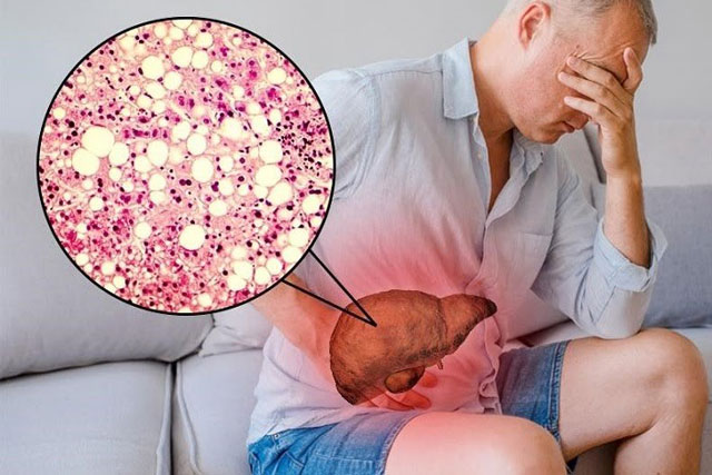 Cách để hạ men gan mà không cần thuốc