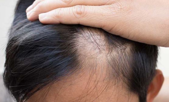 Mảng đầu hói vẫn có thể kích thích tóc mọc lên