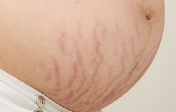 Trị rạn da bằng lòng trắng trứng