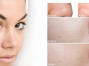 Lỗ chân lông se khít chỉ bằng cách sử dụng rau răm