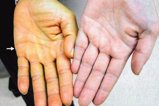 Dấu hiệu cảnh báo gan đang kêu cứu