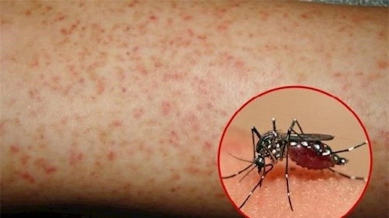 Cách phòng bệnh sốt xuất huyết trong mùa hè