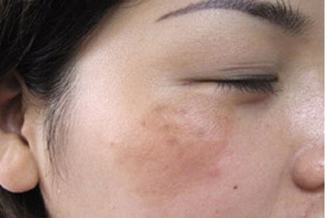 3 công thức giúp bạn tự làm kem trị nám da tại nhà