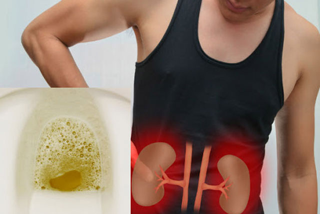 4 dấu hiệu cảnh báo suy thận bạn cần nắm rõ