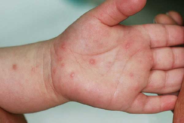 Những điều bạn cần biết về bệnh tay chân miệng ở trẻ nhỏ