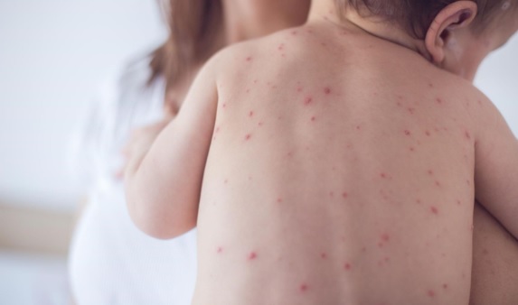 Bệnh về da thường gặp ở trẻ nhỏ mẹ cần lưu ý