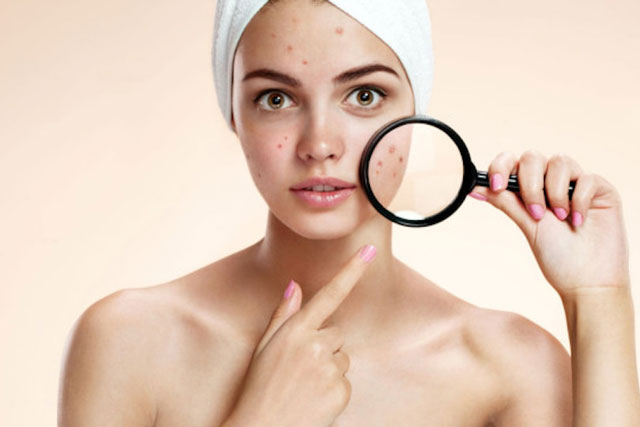 Vị trí mọc mụn báo hiệu tình trạng sức khỏe bên trong