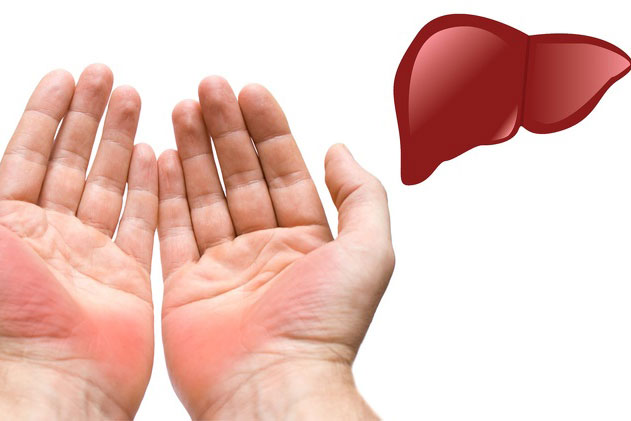 Lưu ý những dấu hiệu cảnh báo ung thư gan