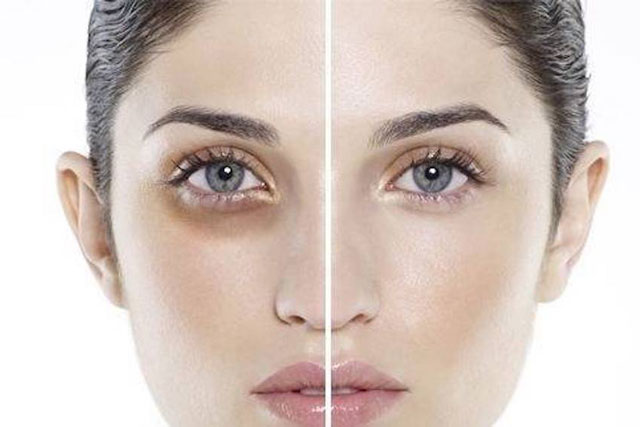 Tạm biệt quầng thâm mắt hiệu quả bằng những phương pháp đơn giản