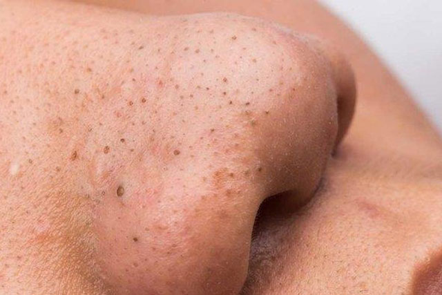 Cách sử dụng trứng gà để trị mụn đầu đen hiệu quả