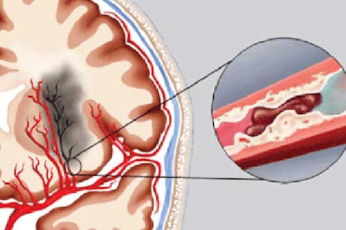 4 triệu chứng sau bữa ăn cảnh báo cơn nhồi máu não sắp đến: Buồn ngủ, đau đầu hãy cảnh giác