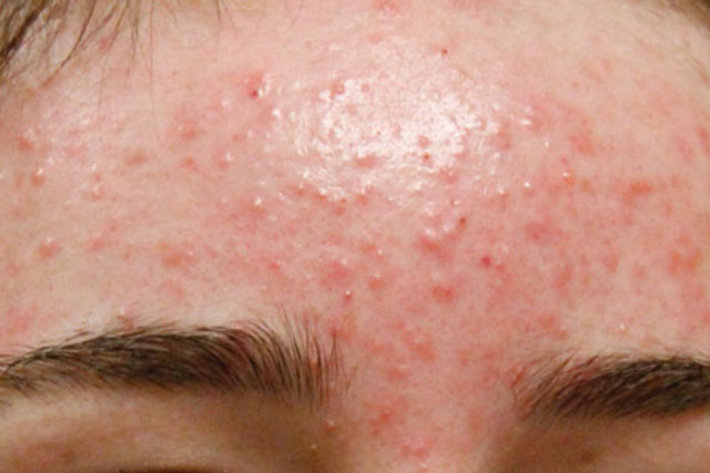 Thủ phạm gây mụn trứng cá không phải ai cũng biết