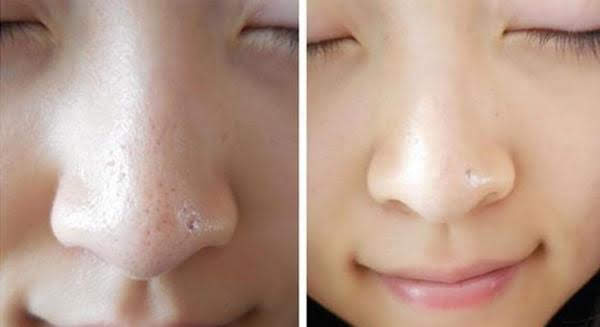 4 mẹo se lỗ chân lông tại nhà