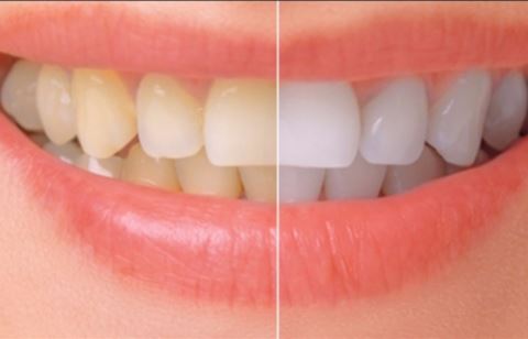 Giúp bạn làm trắng răng tại nhà với 2 công thức đơn giản