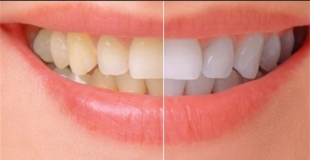 Giúp bạn làm trắng răng tại nhà với 2 công thức đơn giản